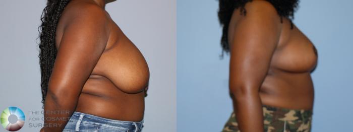 Before & After Breast Reduction Case 12231 Right Side in Denver and Colorado Springs, CO