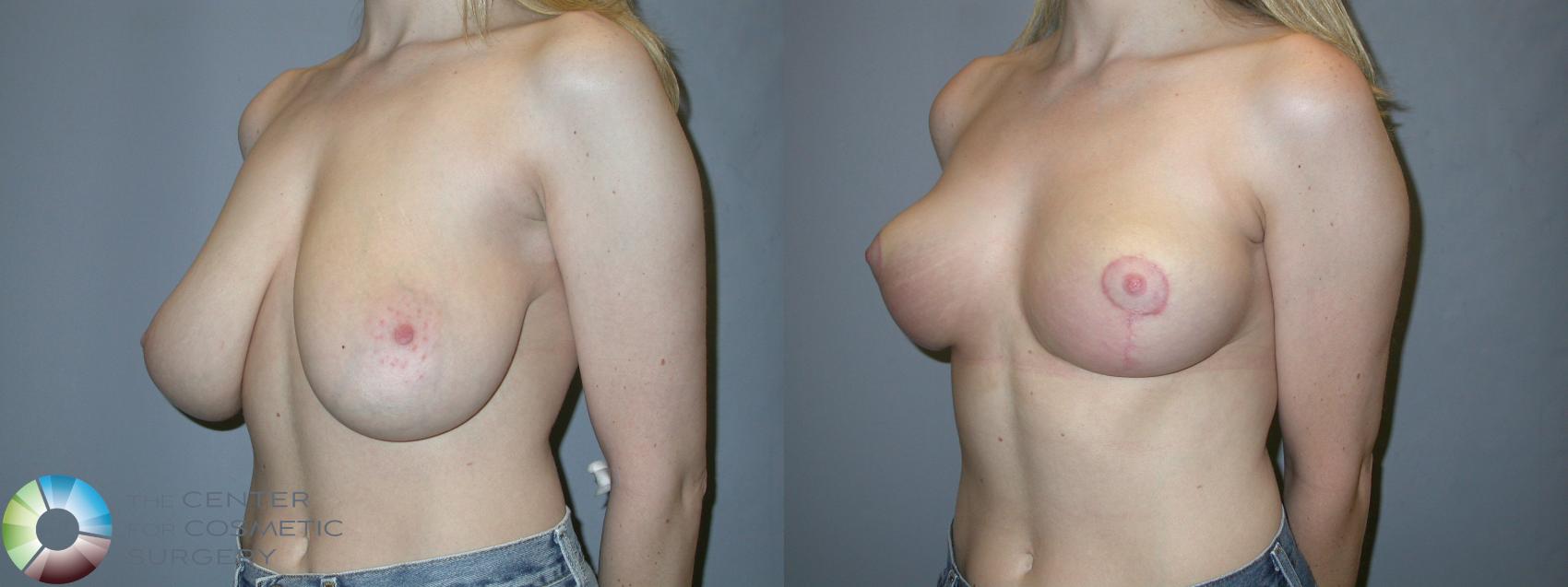 Before & After Breast Reduction Case 215 View #2 View in Golden, CO