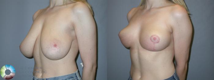 Before & After Breast Reduction Case 215 View #2 in Denver and Colorado Springs, CO