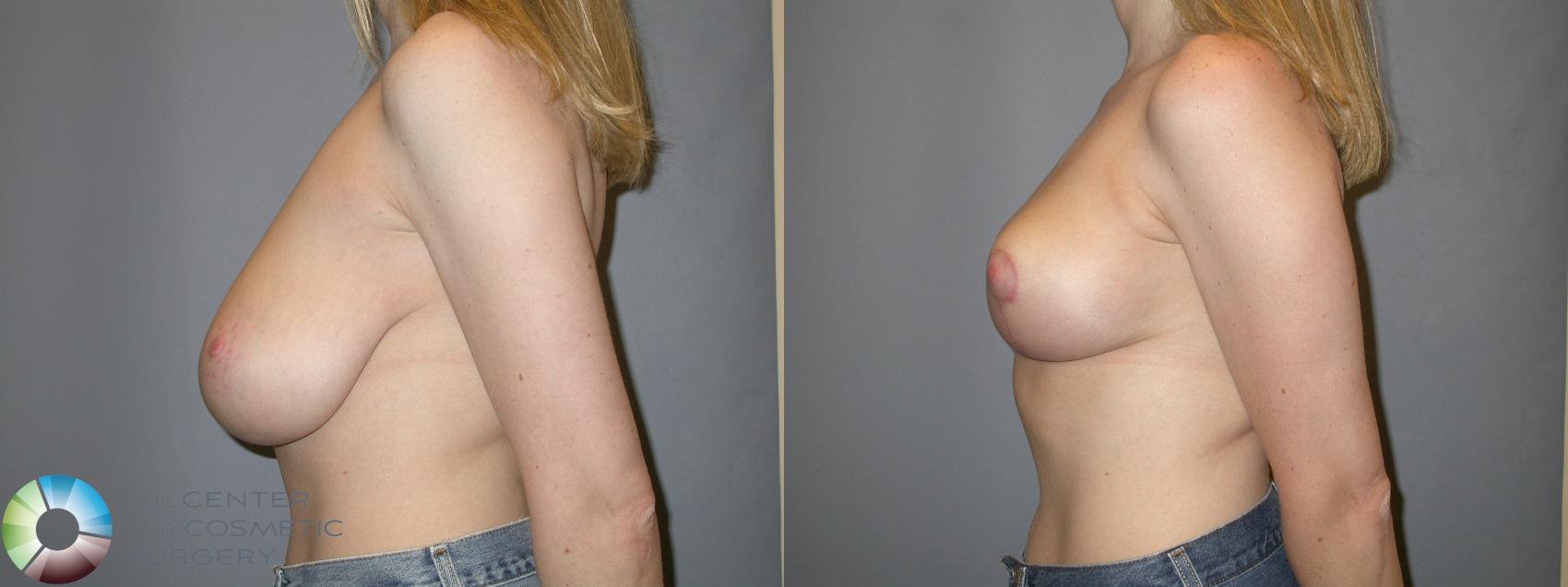 Before & After Breast Reduction Case 215 View #3 View in Golden, CO