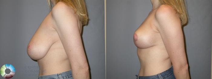 Before & After Breast Reduction Case 215 View #3 in Denver and Colorado Springs, CO