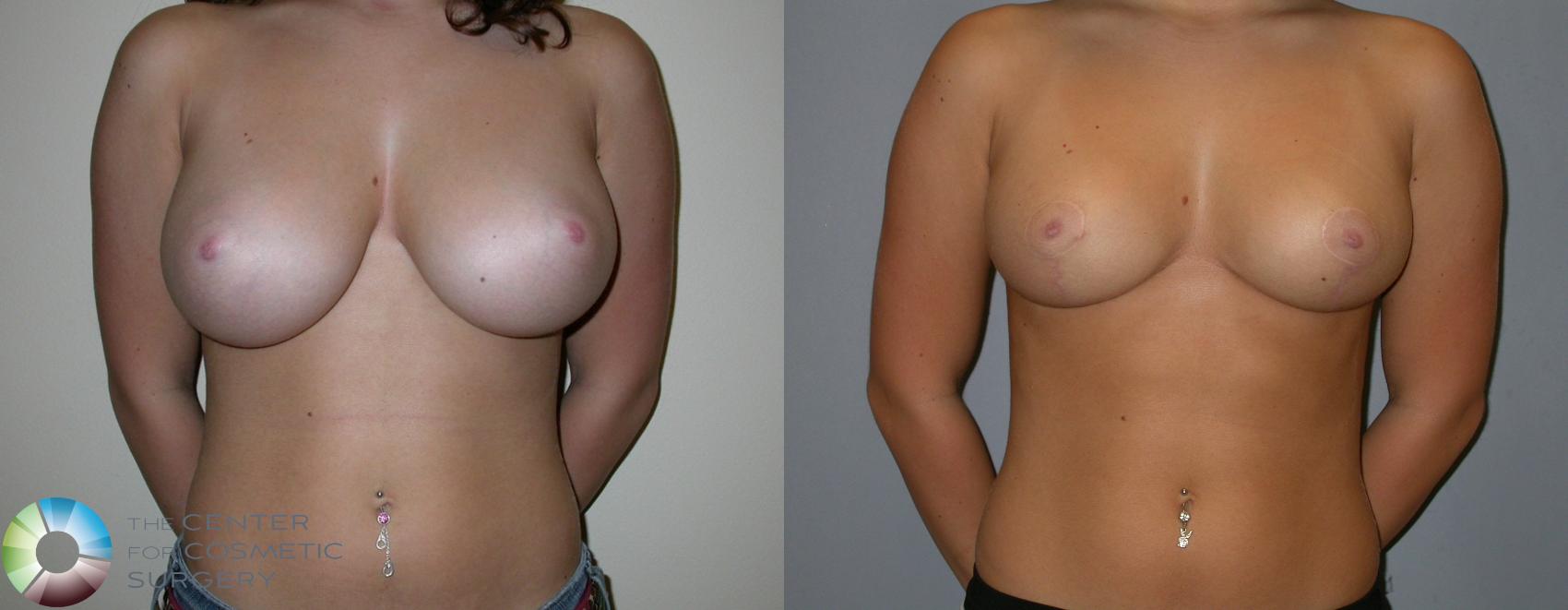 Before & After Breast Reduction Case 217 View #1 in Denver and Colorado Springs, CO