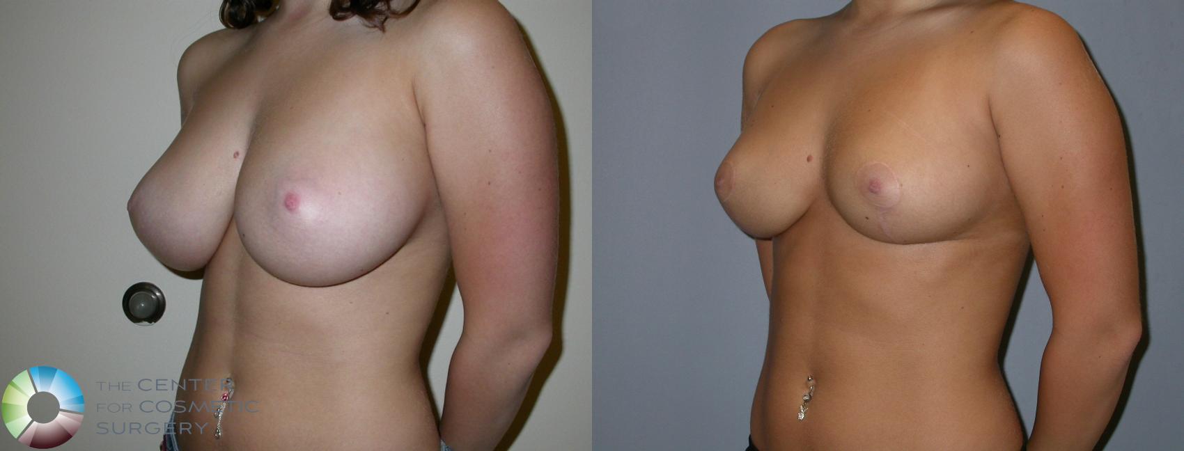 Before & After Breast Reduction Case 217 View #2 View in Denver & Golden, CO