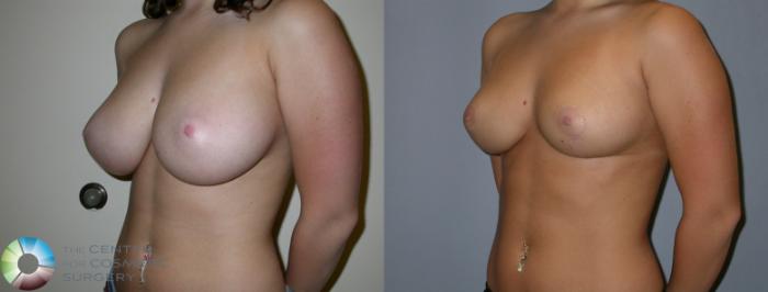Before & After Breast Reduction Case 217 View #2 View in Golden, CO