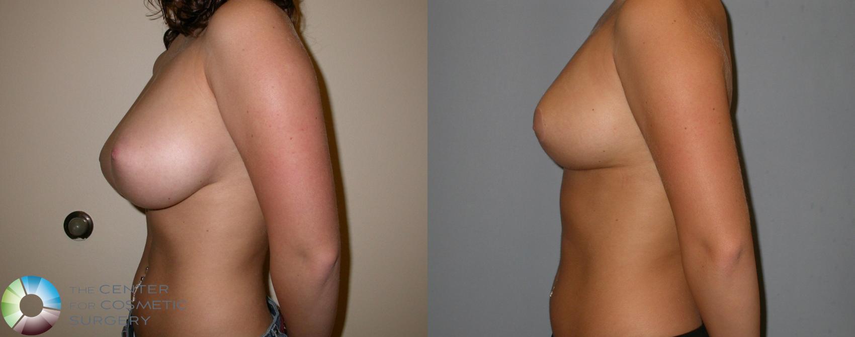 Before & After Breast Reduction Case 217 View #3 View in Golden, CO