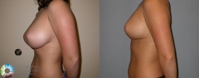 Before & After Breast Reduction Case 217 View #3 View in Golden, CO