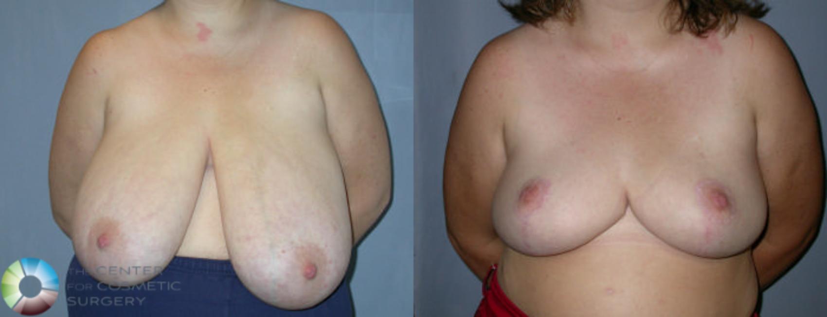 Before & After Breast Reduction Case 25 View #1 in Denver and Colorado Springs, CO