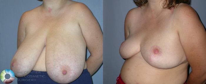 Before & After Breast Reduction Case 25 View #2 View in Golden, CO