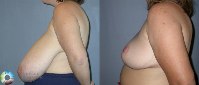Before & After Breast Reduction Case 25 View #3 View in Golden, CO