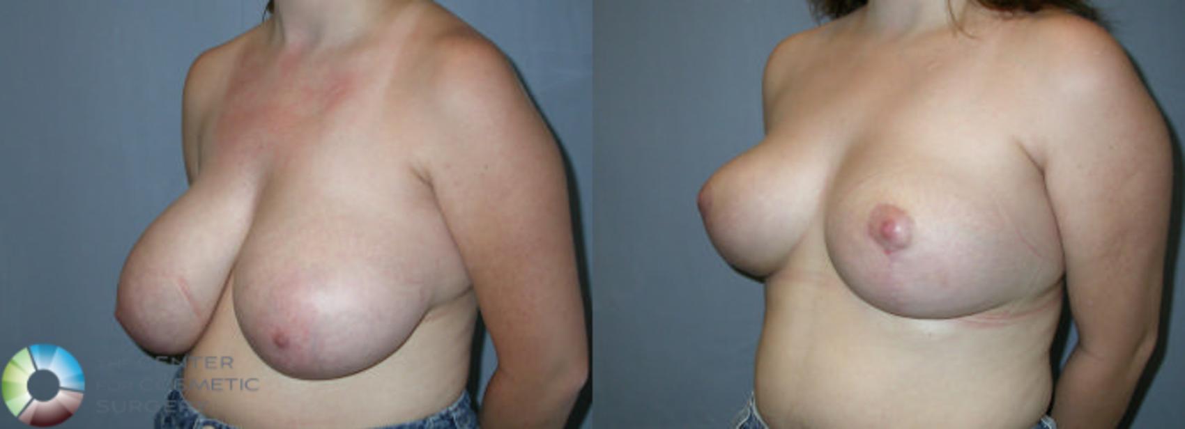 Before & After Breast Reduction Case 27 View #2 View in Denver & Golden, CO