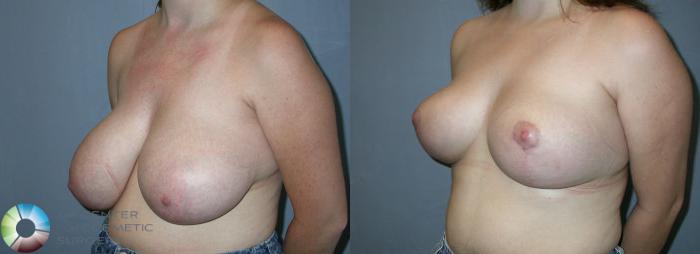 Before & After Breast Reduction Case 27 View #2 View in Golden, CO