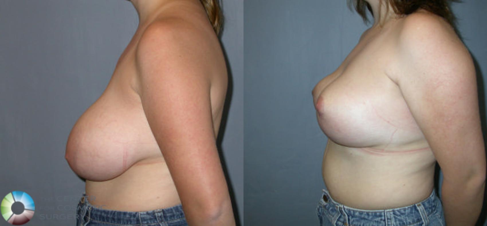 Before & After Breast Reduction Case 27 View #3 View in Denver & Golden, CO