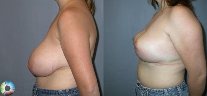 Before & After Breast Reduction Case 27 View #3 View in Golden, CO