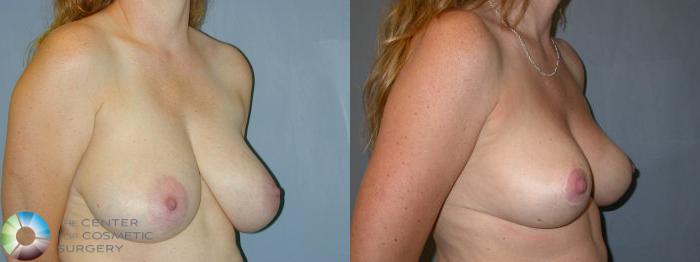 Before & After Breast Reduction Case 28 View #2 in Denver and Colorado Springs, CO