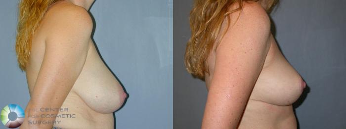 Before & After Breast Reduction Case 28 View #3 in Denver and Colorado Springs, CO