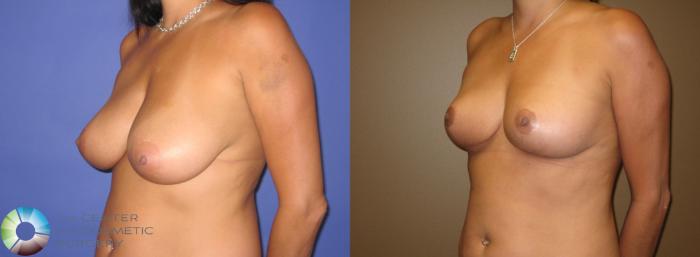 Before & After Breast Reduction Case 293 View #1 View in Golden, CO