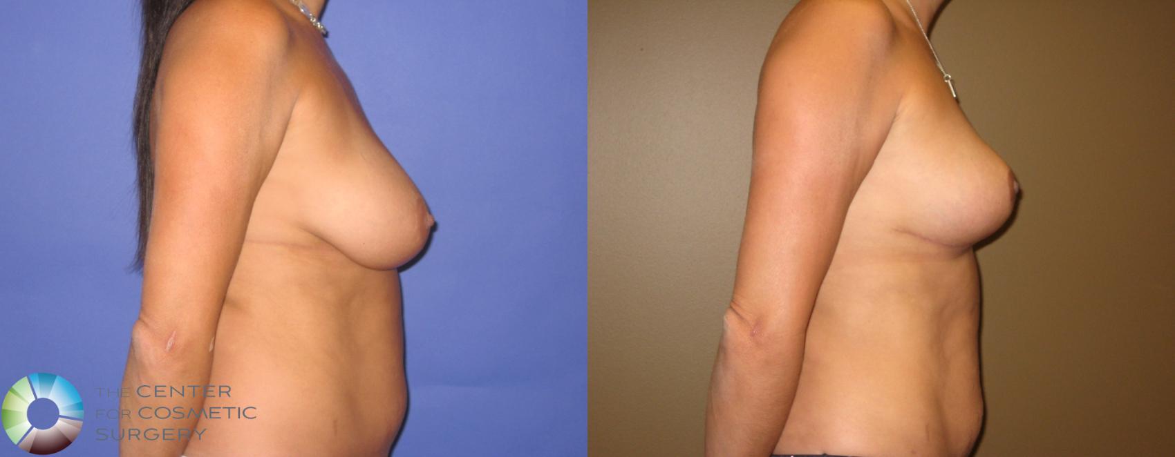Before & After Breast Reduction Case 293 View #3 in Denver and Colorado Springs, CO