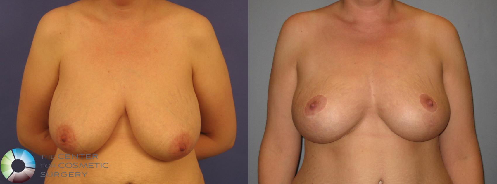 Before & After Breast Reduction Case 370 View #1 in Denver and Colorado Springs, CO