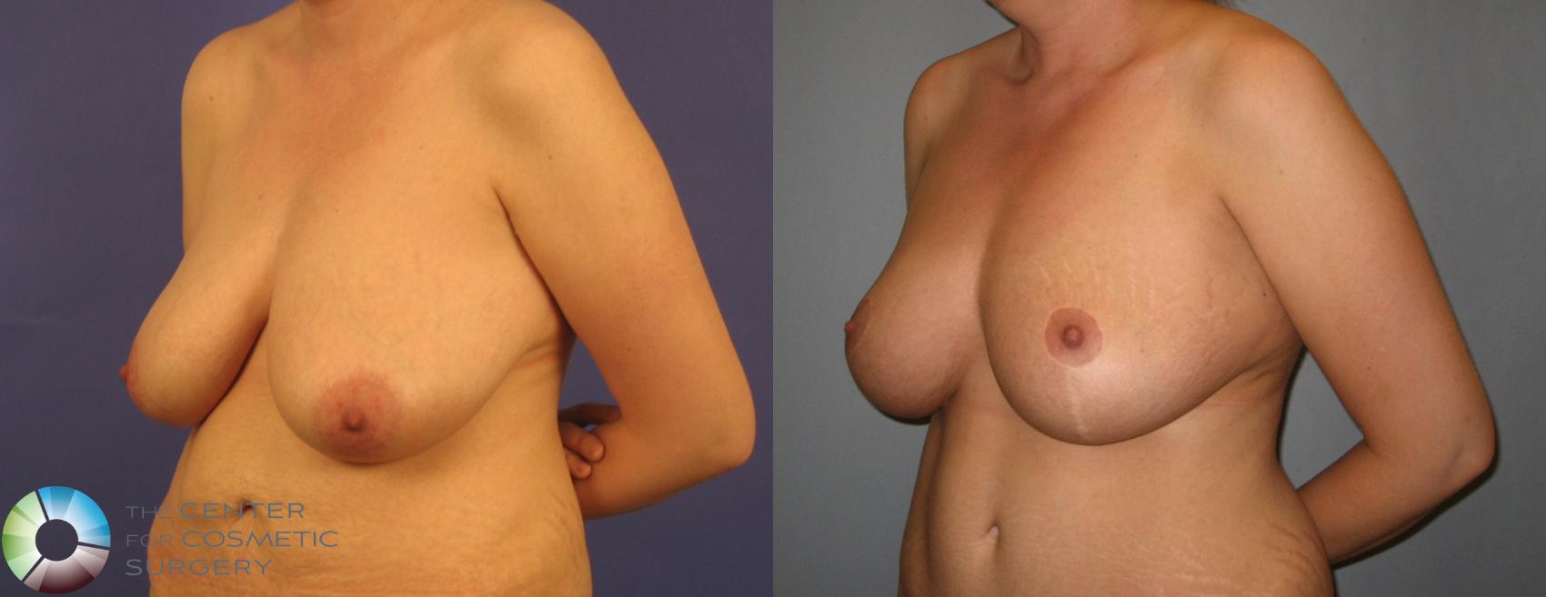 Before & After Breast Reduction Case 370 View #2 in Denver and Colorado Springs, CO