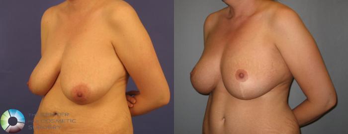 Before & After Breast Reduction Case 370 View #2 View in Golden, CO
