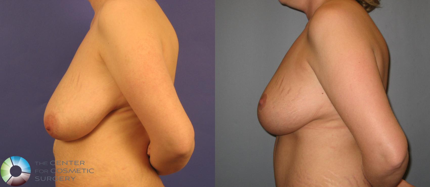 Before & After Breast Reduction Case 370 View #3 in Denver and Colorado Springs, CO