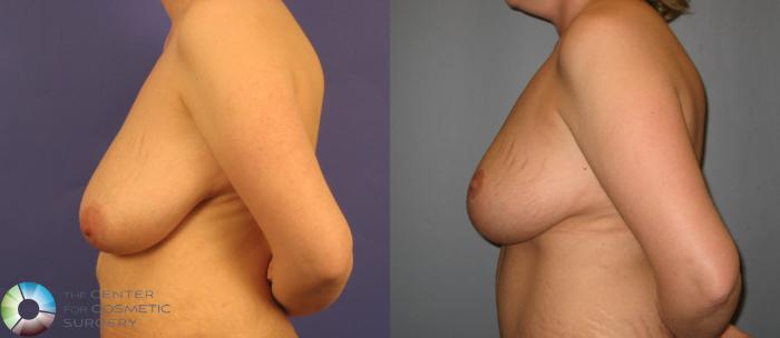 Before & After Breast Reduction Case 370 View #3 View in Golden, CO