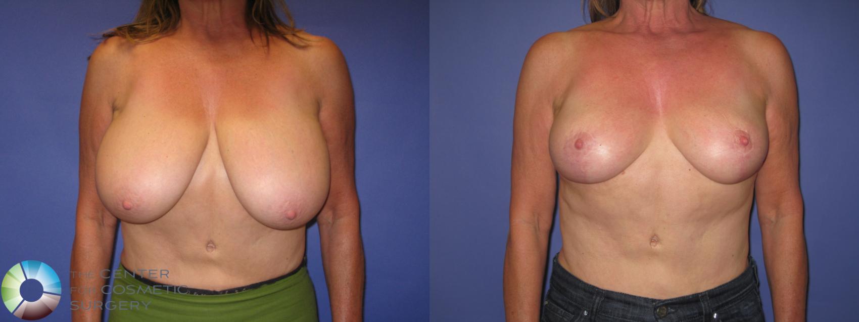 Before & After Breast Reduction Case 389 View #1 in Denver and Colorado Springs, CO