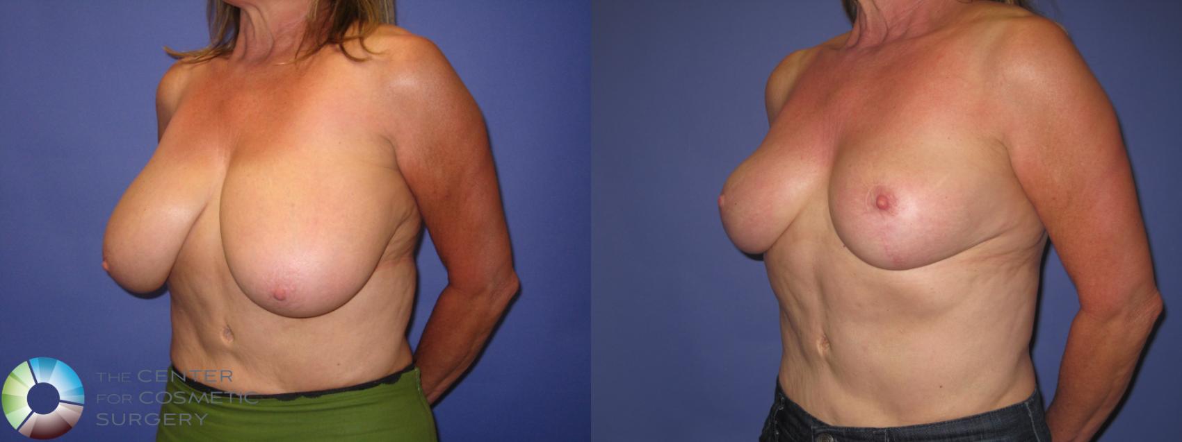 Before & After Breast Reduction Case 389 View #2 View in Golden, CO