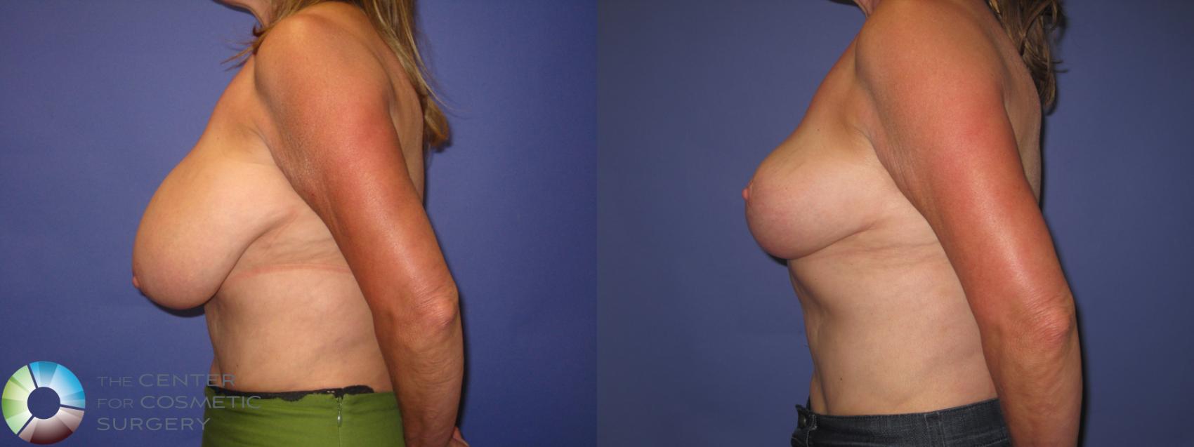 Before & After Breast Reduction Case 389 View #3 View in Golden, CO