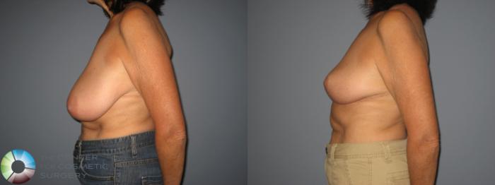 Before & After Breast Reduction Case 396 View #2 View in Golden, CO