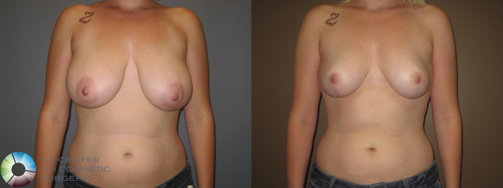 Before & After Breast Reduction Case 403 View #1 in Denver and Colorado Springs, CO