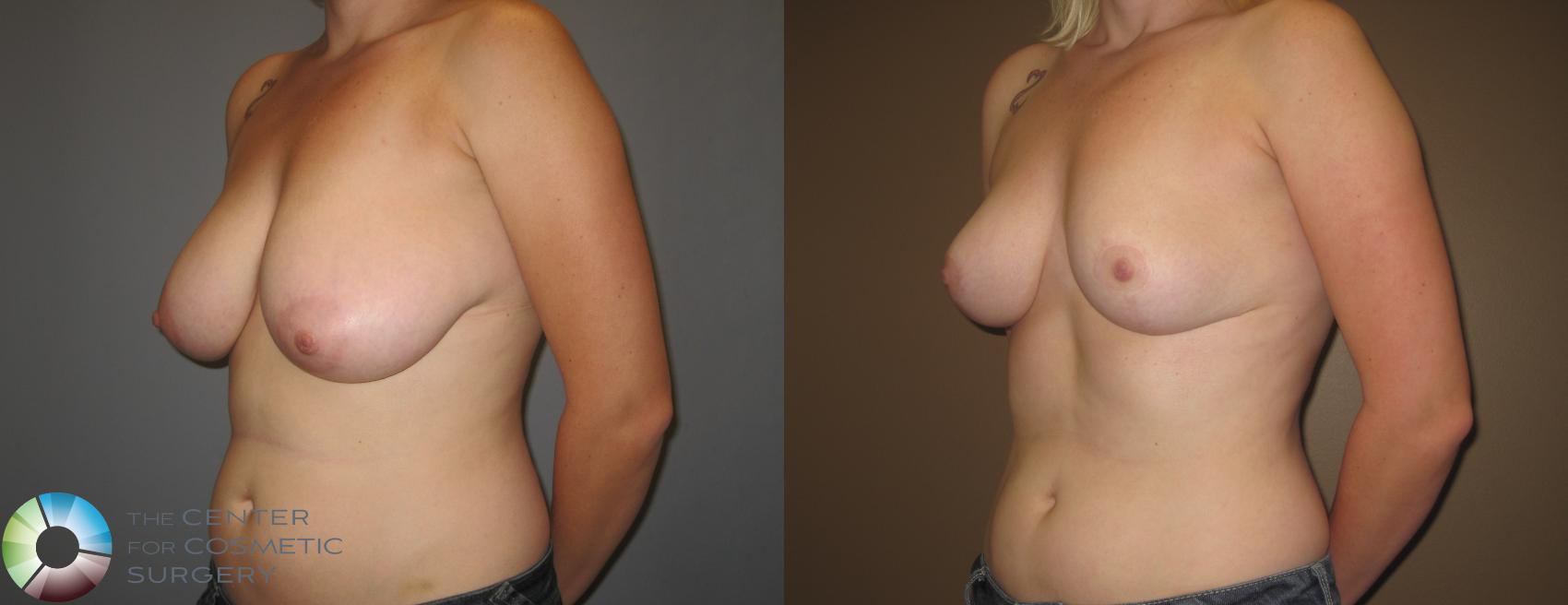 Before & After Breast Reduction Case 403 View #2 View in Golden, CO