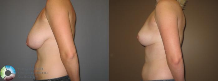 Before & After Breast Reduction Case 403 View #3 View in Golden, CO