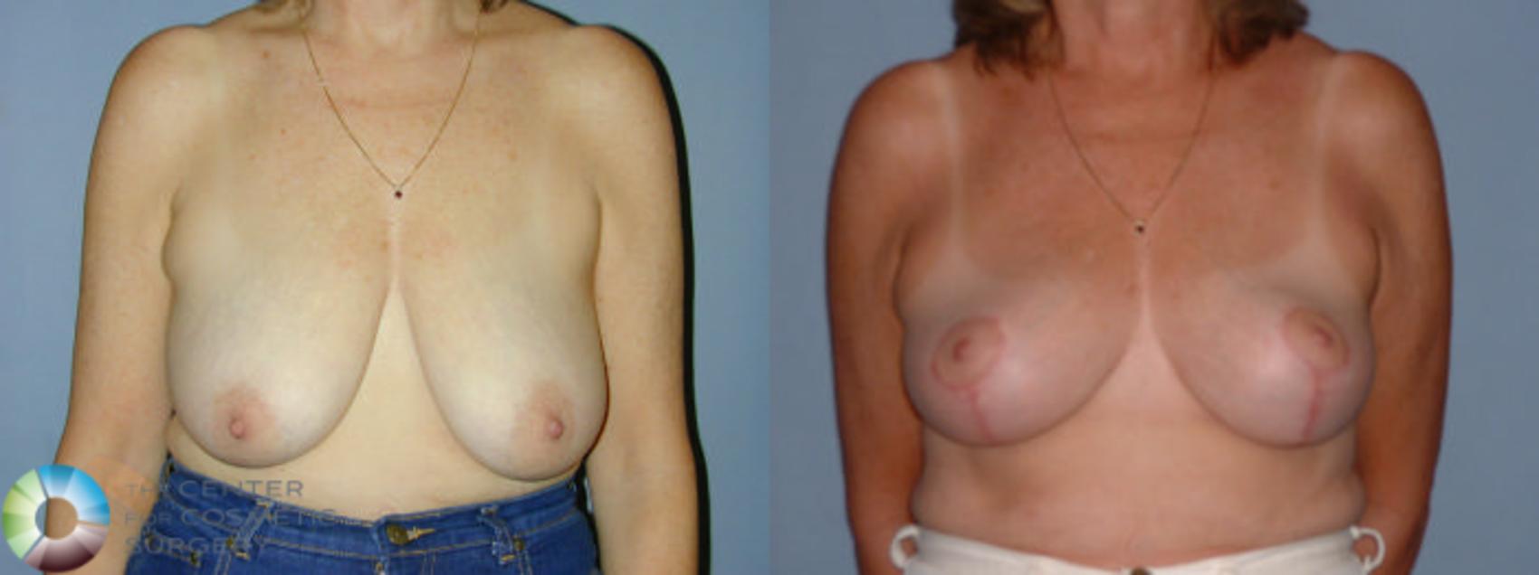 Before & After Breast Reduction Case 42 View #1 in Denver and Colorado Springs, CO