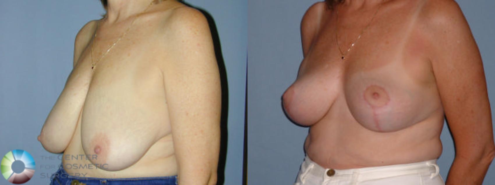 Before & After Breast Reduction Case 42 View #2 View in Denver & Golden, CO