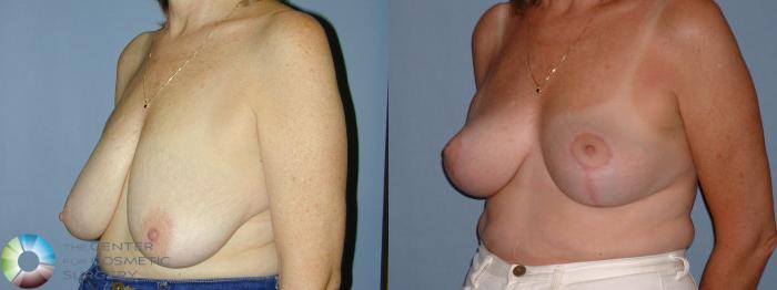Before & After Breast Reduction Case 42 View #2 View in Golden, CO
