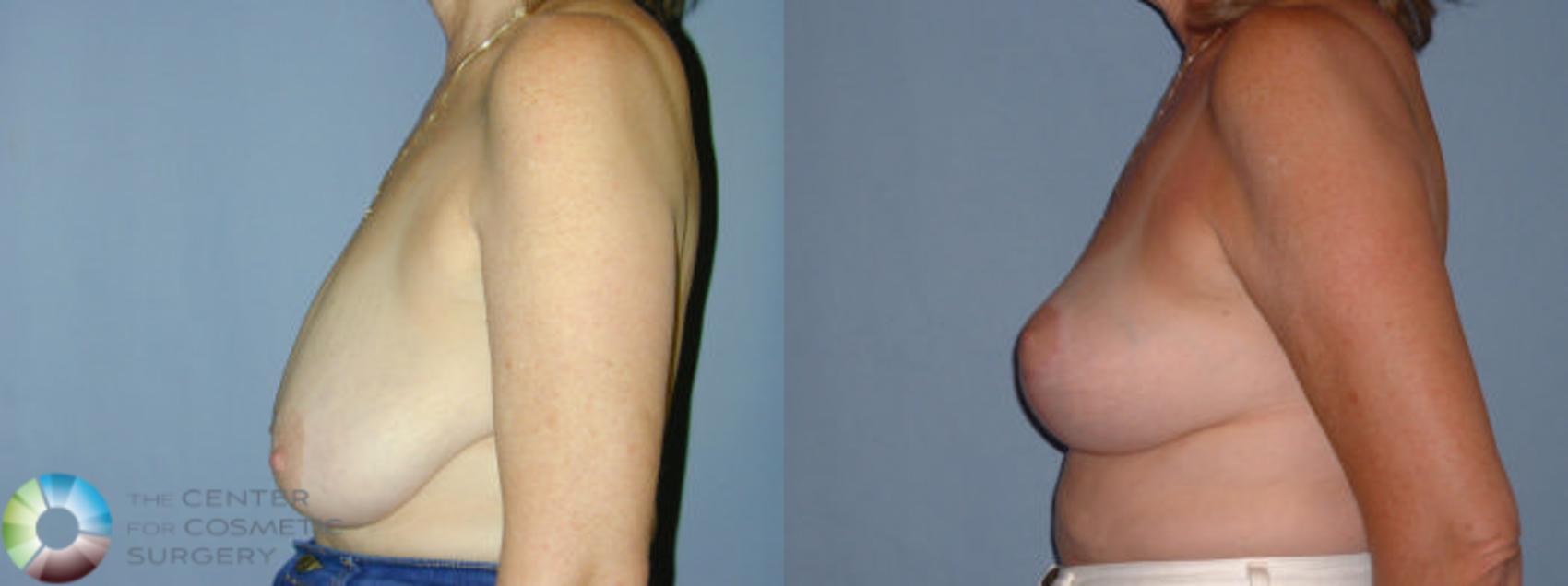 Before & After Breast Reduction Case 42 View #3 View in Denver & Golden, CO
