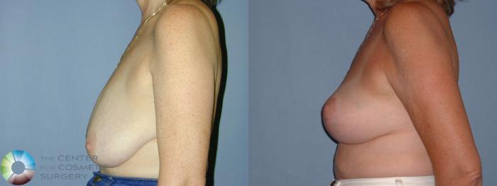 Before & After Breast Reduction Case 42 View #3 View in Golden, CO