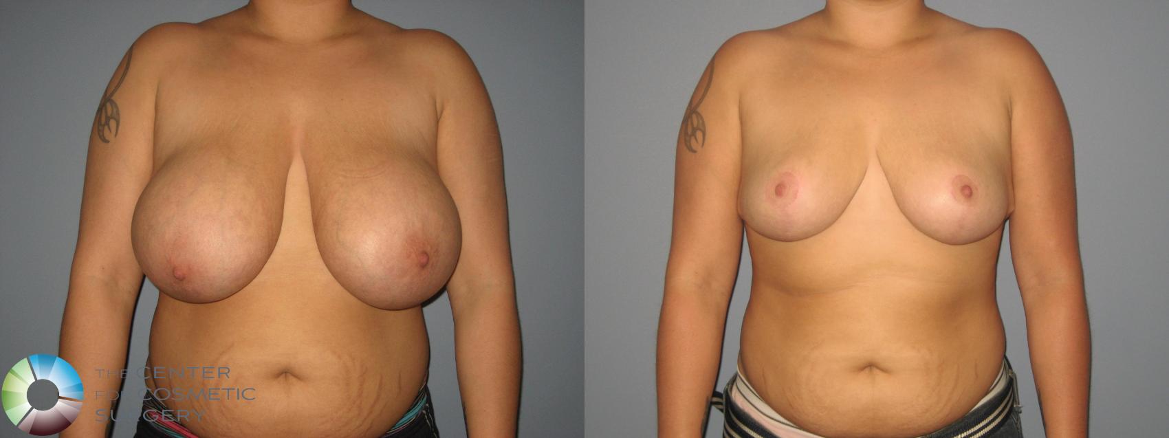 Before & After Breast Reduction Case 437 View #1 in Denver and Colorado Springs, CO