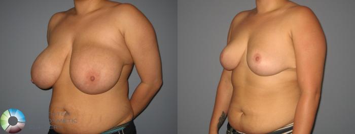 Before & After Breast Reduction Case 437 View #2 in Denver and Colorado Springs, CO