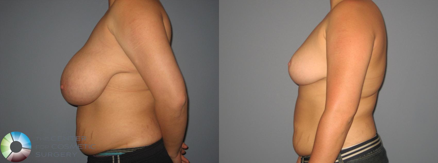 Before & After Breast Reduction Case 437 View #3 in Denver and Colorado Springs, CO