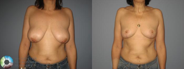 Before & After Breast Reduction Case 449 View #1 View in Golden, CO