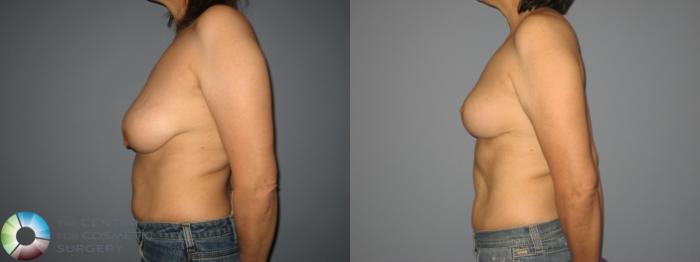 Before & After Breast Reduction Case 449 View #2 View in Golden, CO