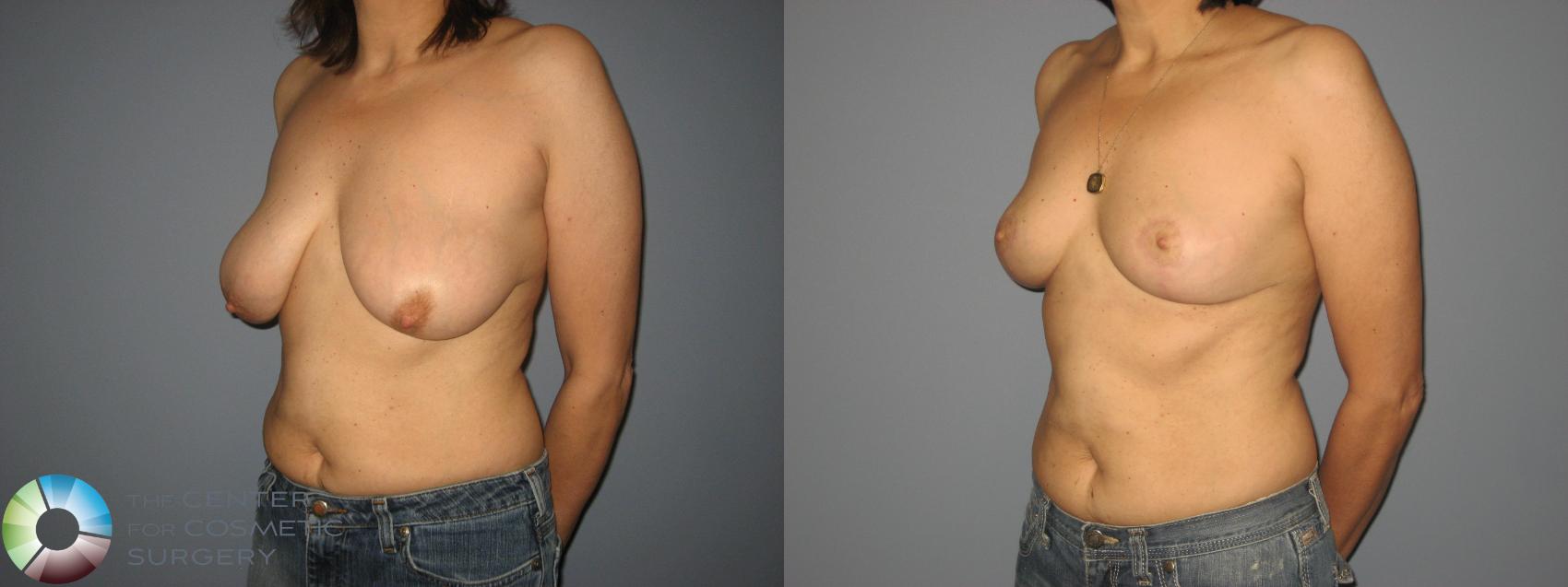 Before & After Breast Reduction Case 449 View #3 View in Golden, CO