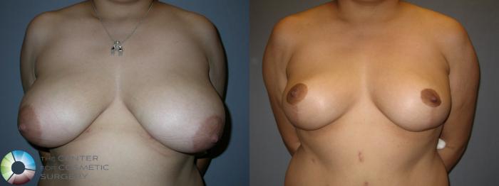 Before & After Breast Reduction Case 47 View #1 in Denver and Colorado Springs, CO