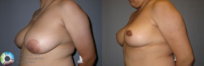 Before & After Breast Reduction Case 47 View #2 in Denver and Colorado Springs, CO