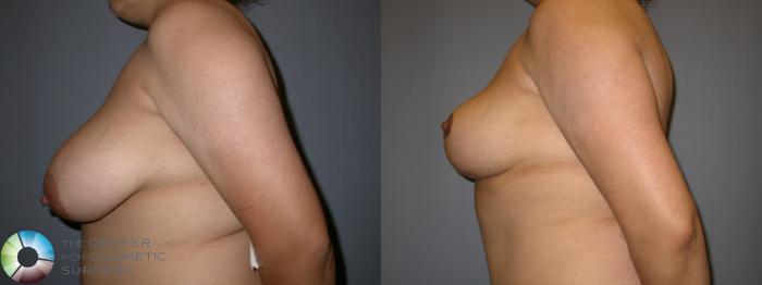 Before & After Breast Reduction Case 47 View #3 in Denver and Colorado Springs, CO