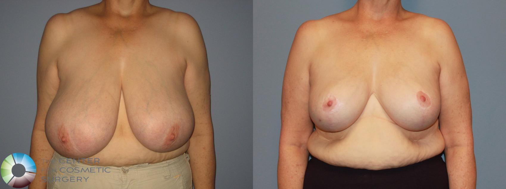 Before & After Breast Reduction Case 483 View #1 in Denver and Colorado Springs, CO