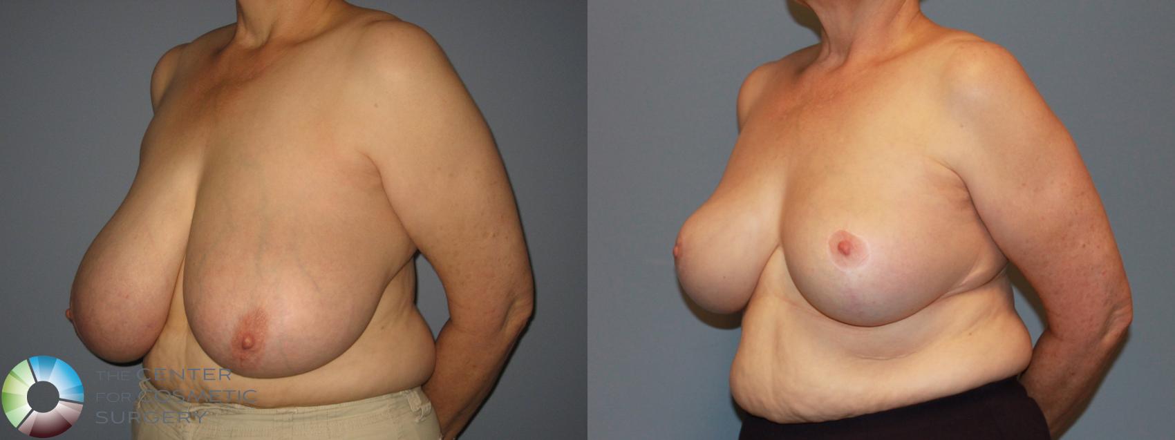 Before & After Breast Reduction Case 483 View #2 in Denver and Colorado Springs, CO