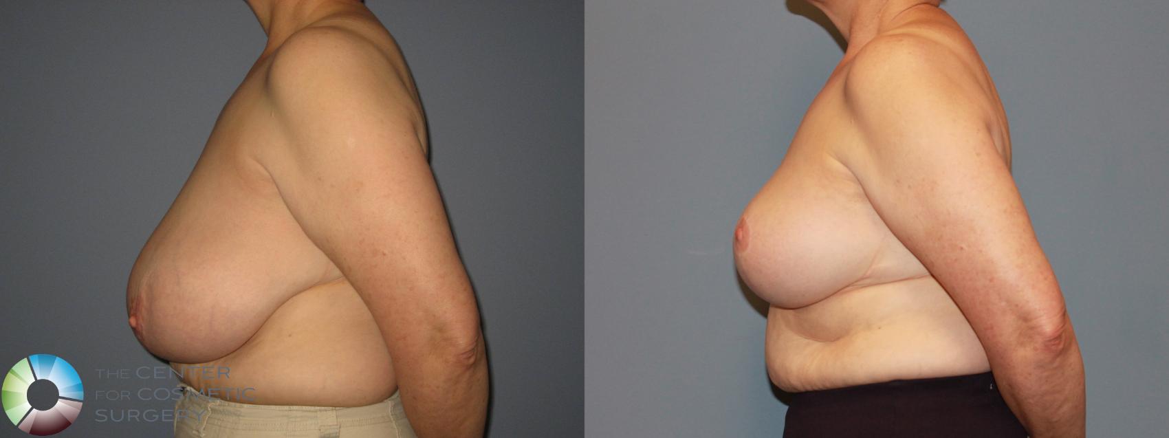 Before & After Breast Reduction Case 483 View #3 in Denver and Colorado Springs, CO